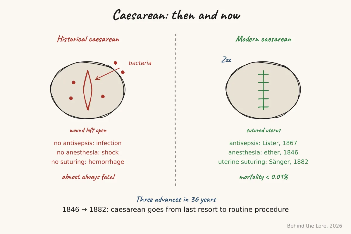 Comparative diagram of a historical caesarean section and a modern caesarean section with uterine suturing