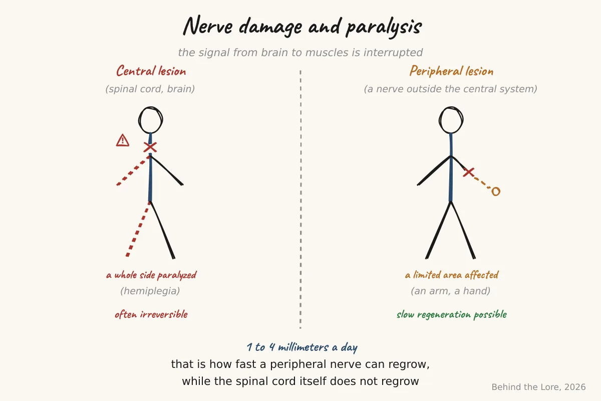 Comparative diagram of central lesions (spinal cord) and peripheral lesions (nerve) causing one-sided paralysis