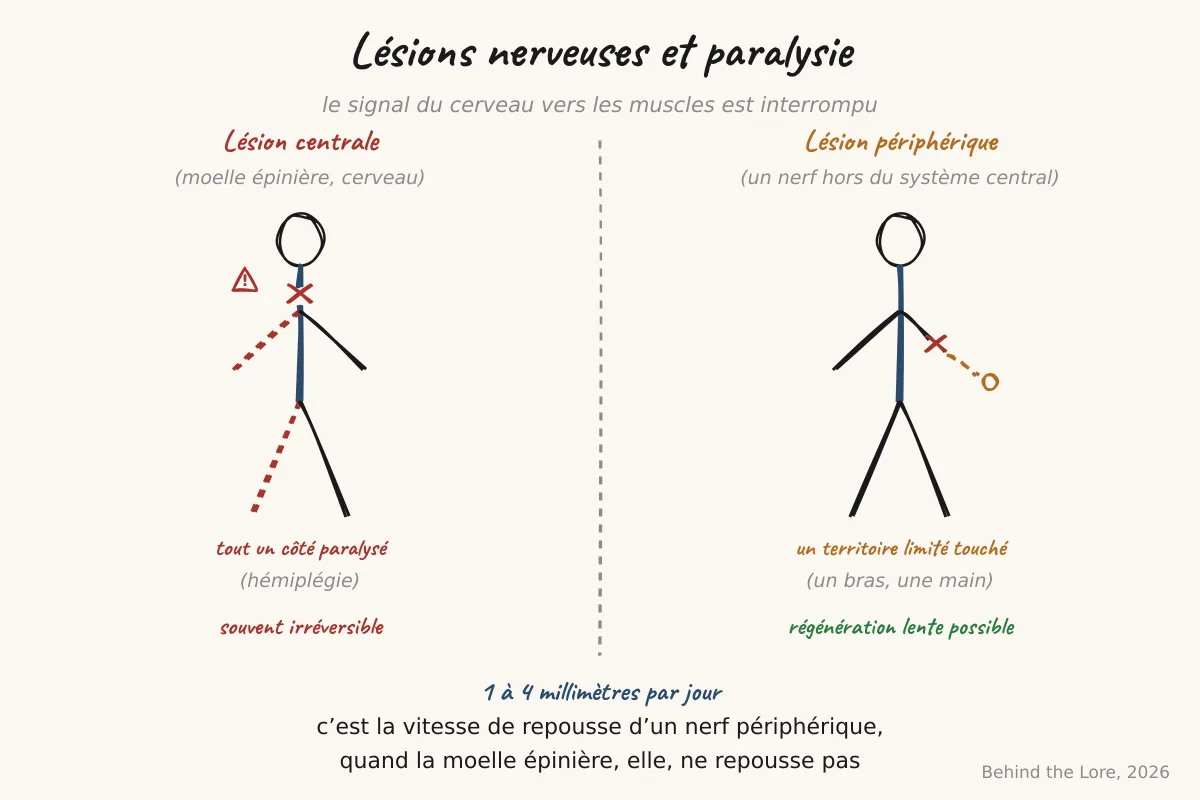 Schéma comparatif lésion centrale (moelle épinière) et lésion périphérique (nerf) entraînant une paralysie unilatérale