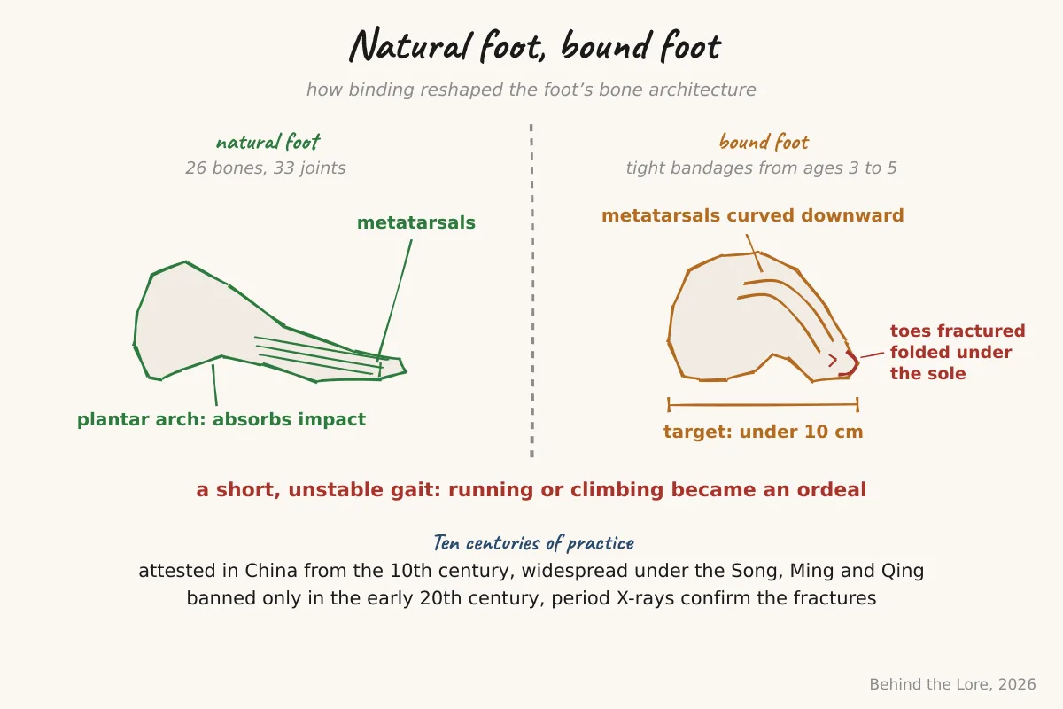 Comparative diagram of a natural foot and a bound foot showing the metatarsal bone deformation