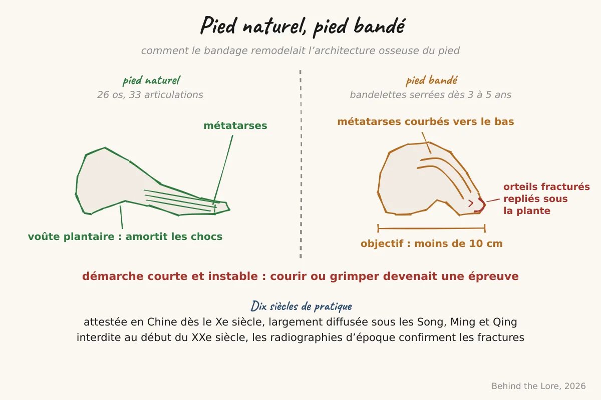 Schéma comparatif d'un pied naturel et d'un pied bandé montrant la déformation osseuse des métatarses