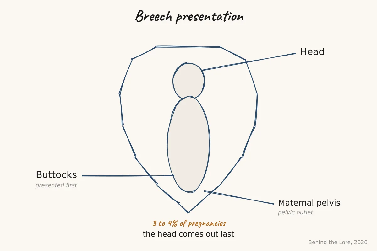 Diagram illustrating a fetus in breech presentation within the uterus